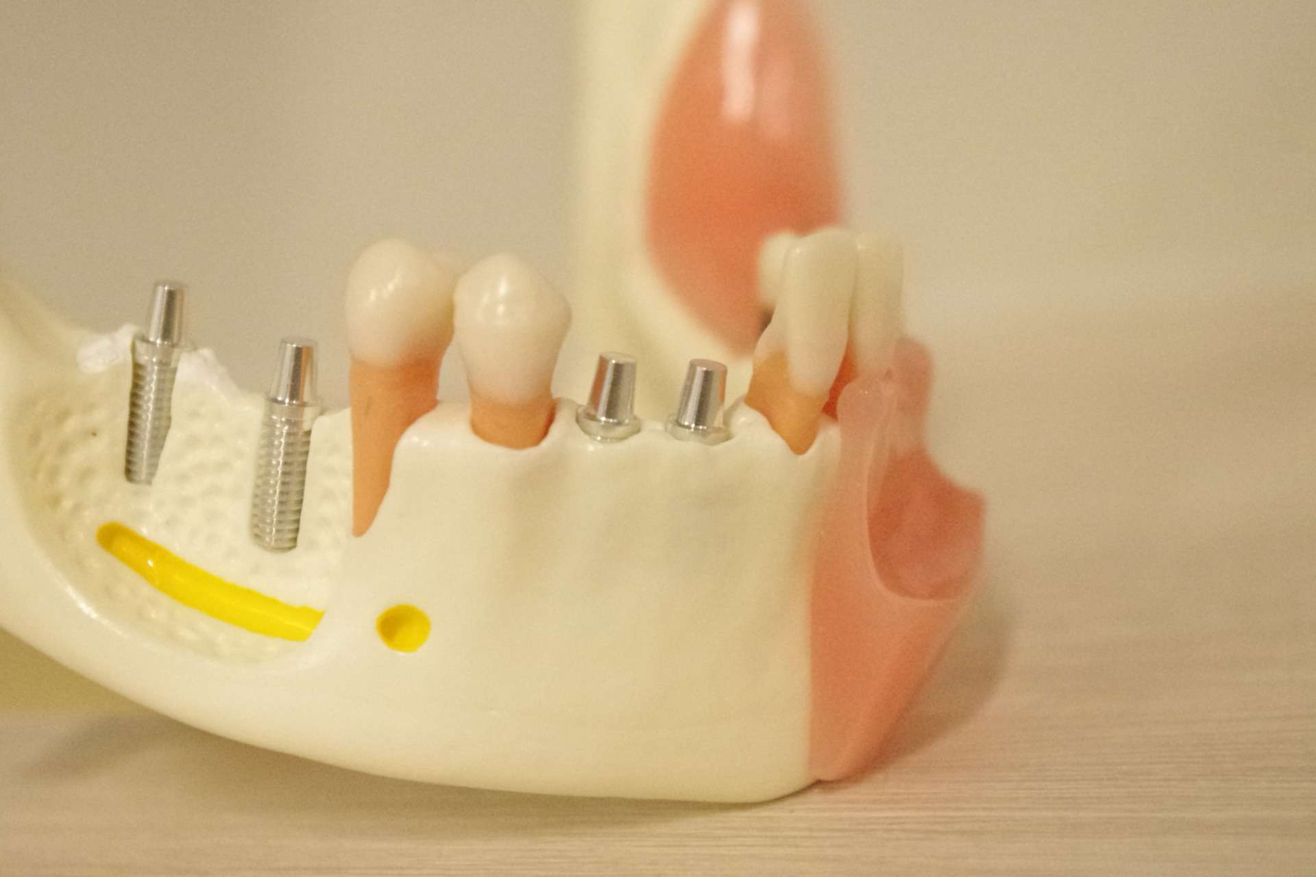 インプラント/入れ歯