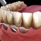 歯を保存する治療