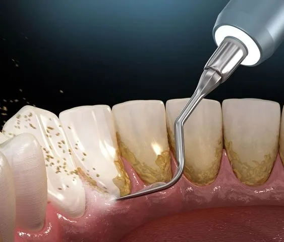歯石を除去する方法って？