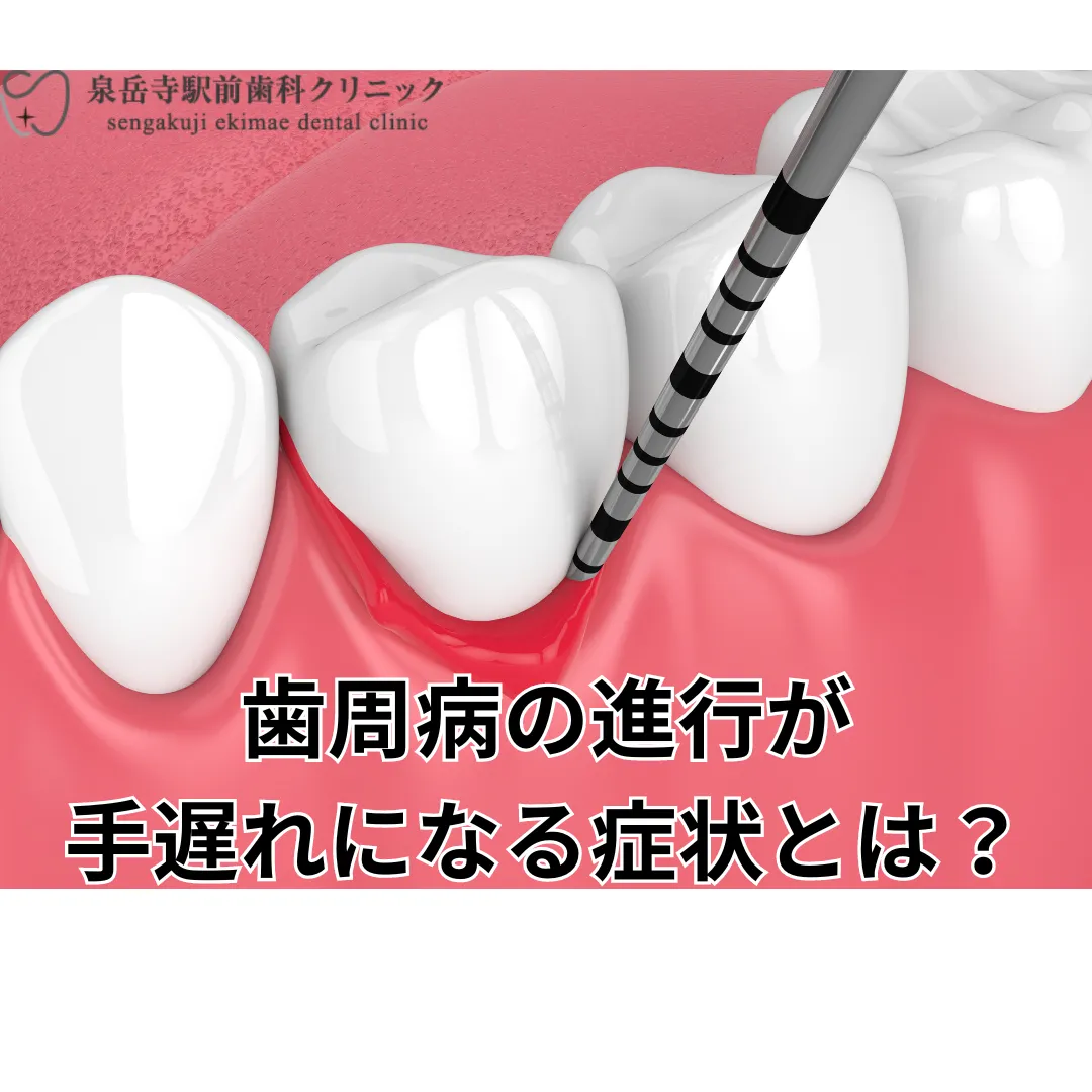 歯周病が手遅れになる症状とは？