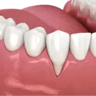 下がった歯ぐきの治療
