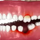 歯周病と矯正治療